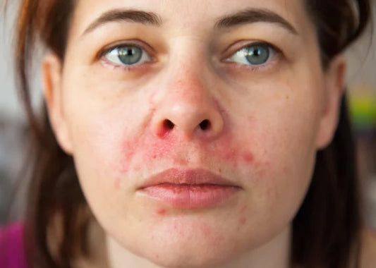 Perioral Dermatitis Treatments: Heal the Rash Around Your Mouth & Nose